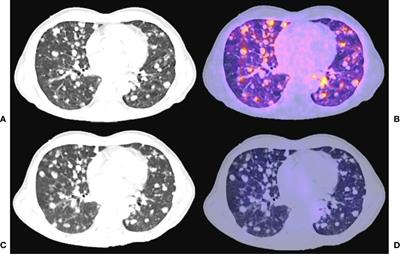 Head-to-Head Comparison of 68Ga-PSMA-11 and 131I in the Follow-Up of Well-Differentiated Metastatic Thyroid Cancer: A New Potential Theragnostic Agent